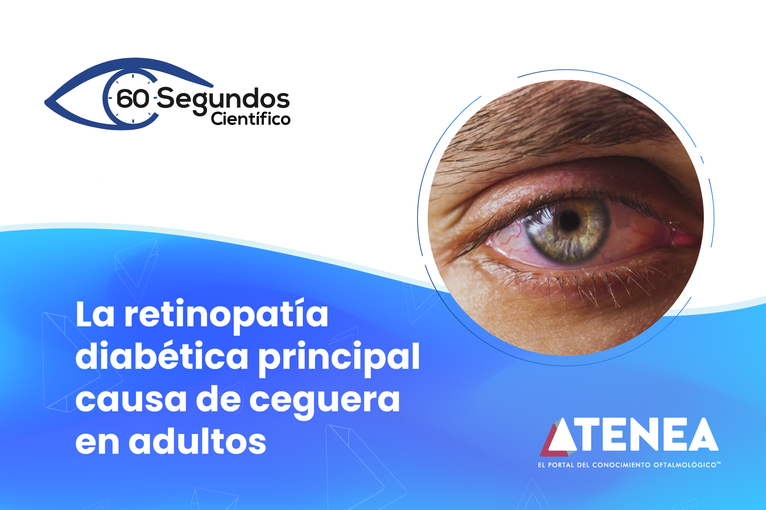 Calculador ESCRS fb La retinopatía diabética principal causa de ceguera en adultos